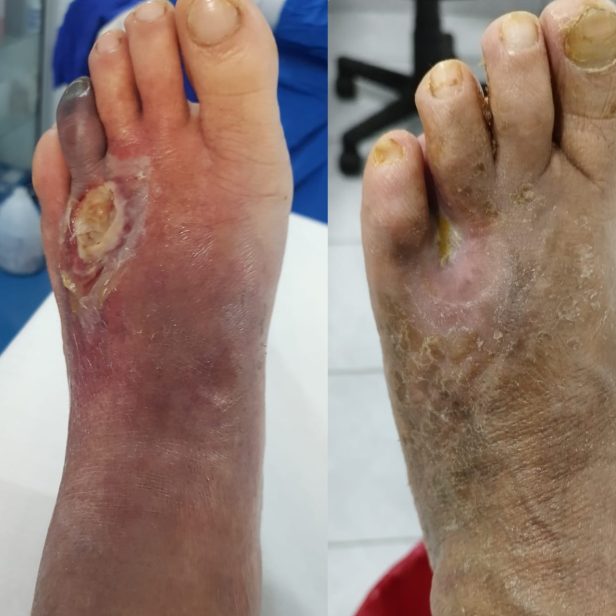 Tratamiento pie diabetico2
